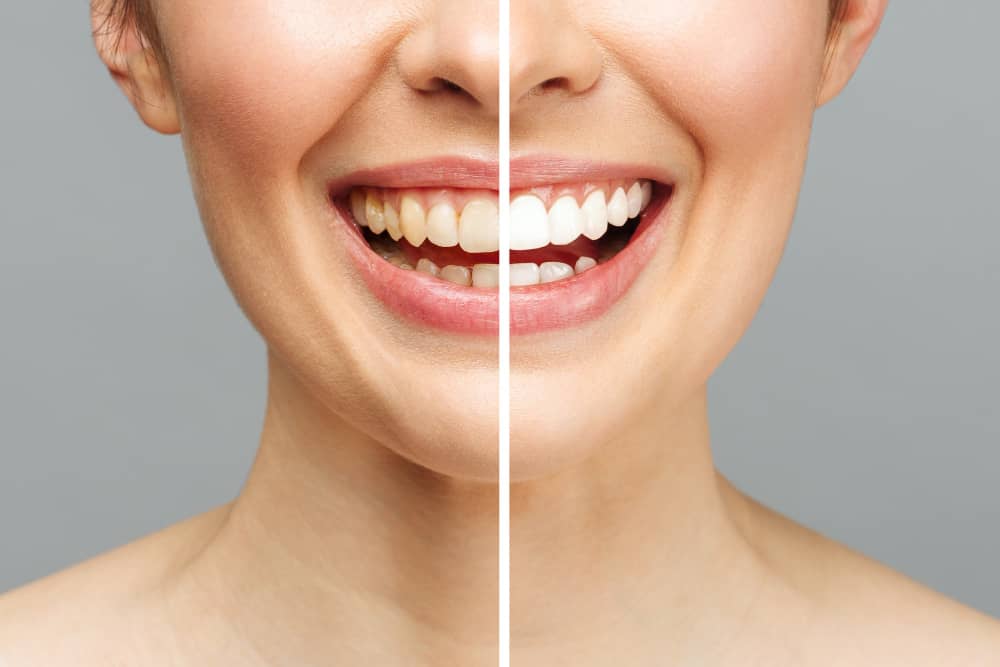 pulizia-denti